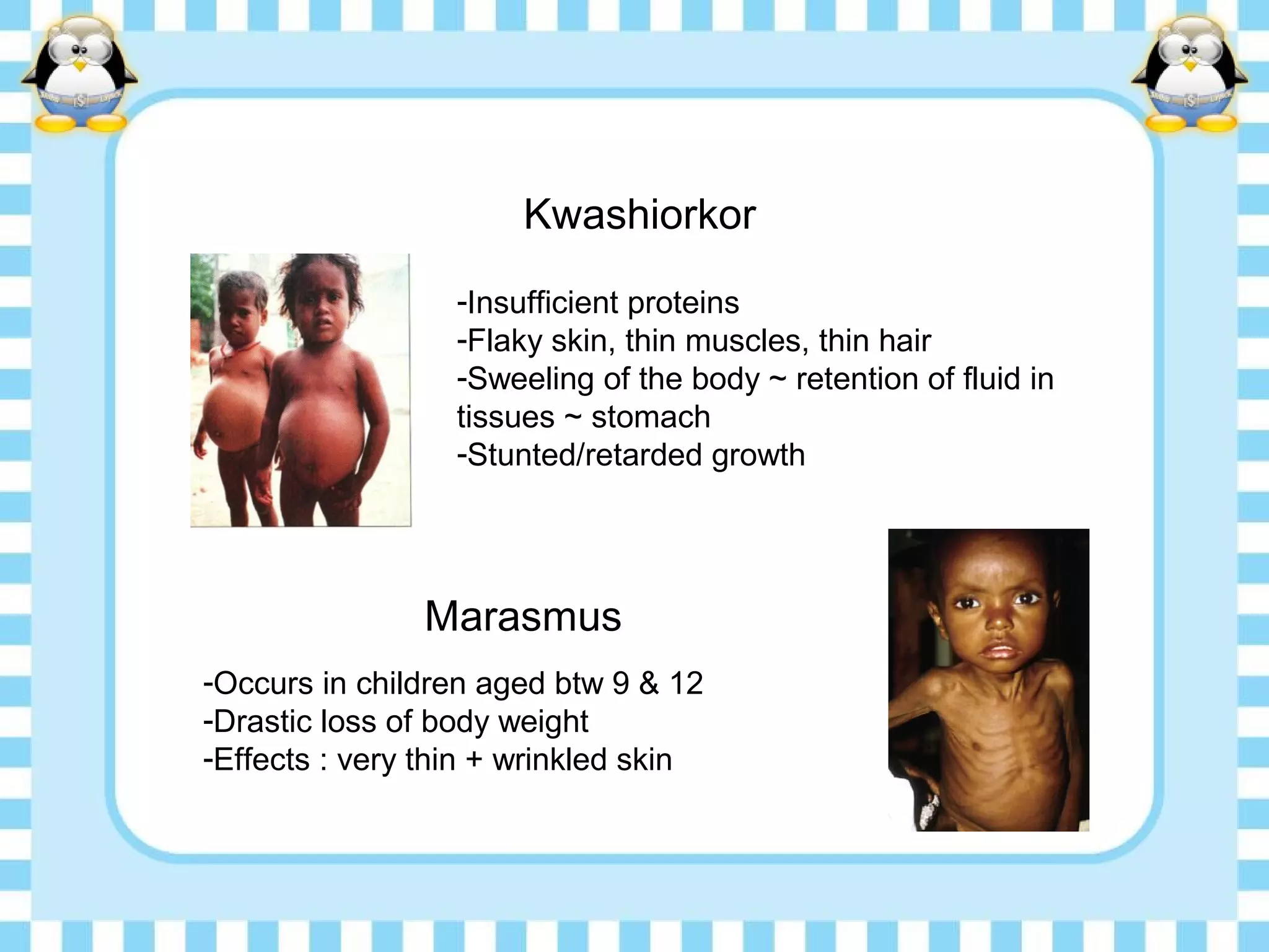 -Insufficient proteins
-Flaky skin, thin muscles, thin hair
-Sweeling of the body ~ retention of fluid in
tissues ~ stomach
-Stunted/retarded growth
Kwashiorkor
Marasmus
-Occurs in children aged btw 9 & 12
-Drastic loss of body weight
-Effects : very thin + wrinkled skin
 