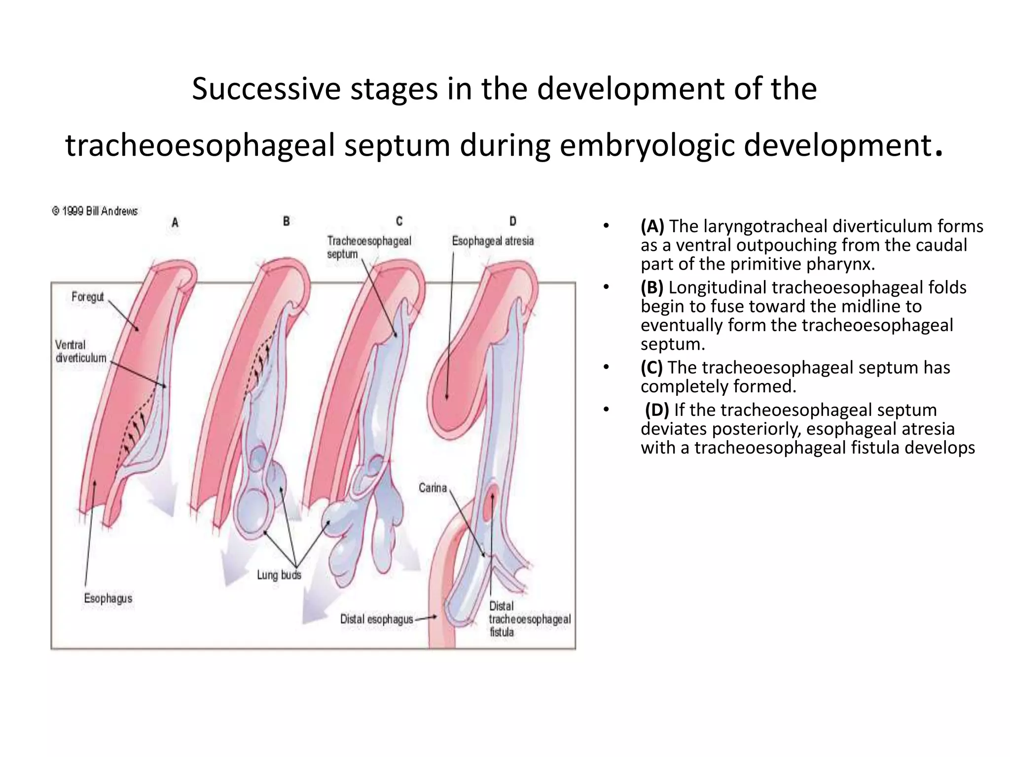 Successive stages in the development of the
tracheoesophageal septum during embryologic development.
• (A) The laryngotracheal diverticulum forms
as a ventral outpouching from the caudal
part of the primitive pharynx.
• (B) Longitudinal tracheoesophageal folds
begin to fuse toward the midline to
eventually form the tracheoesophageal
septum.
• (C) The tracheoesophageal septum has
completely formed.
• (D) If the tracheoesophageal septum
deviates posteriorly, esophageal atresia
with a tracheoesophageal fistula develops
 