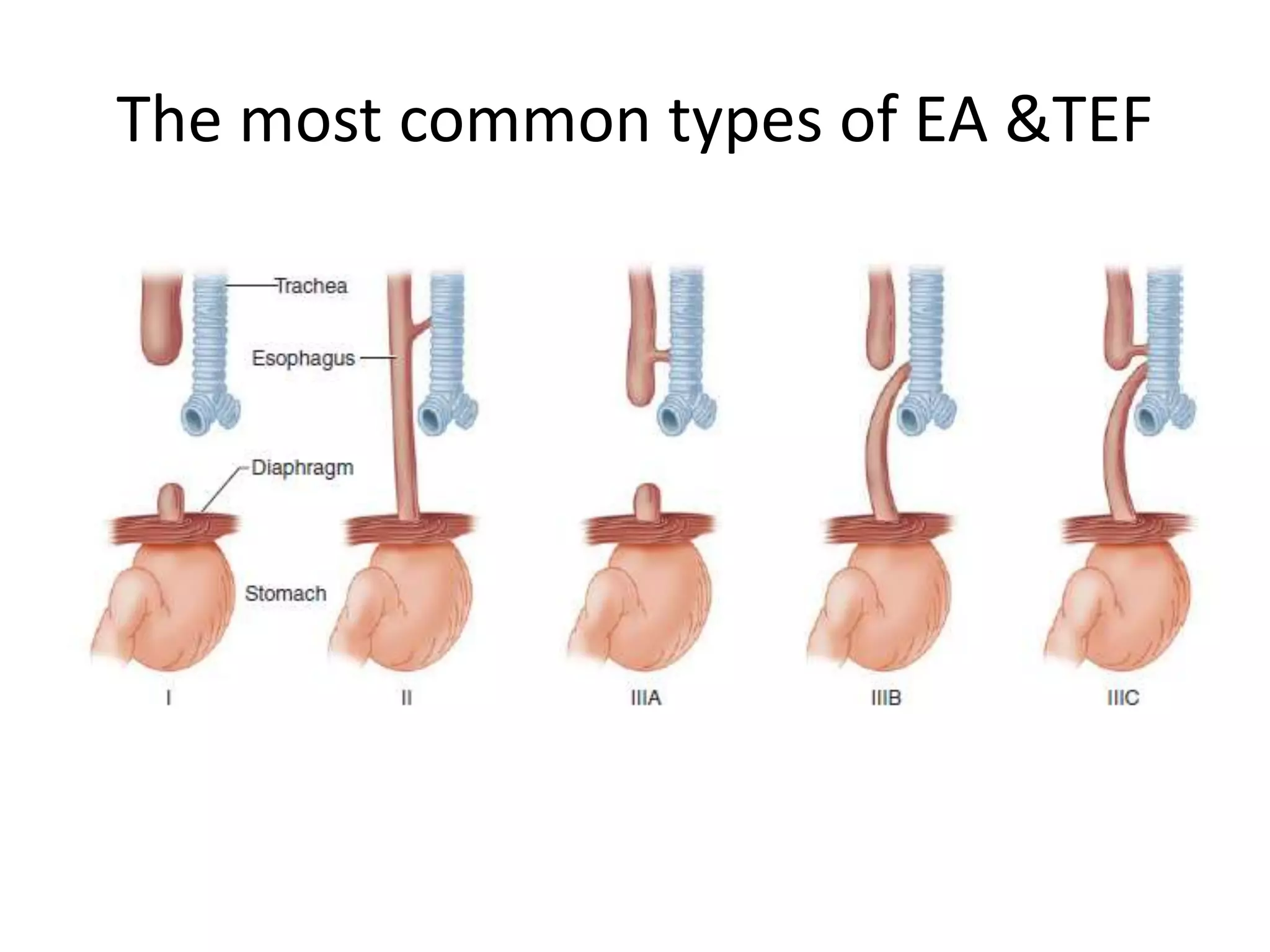 The most common types of EA &TEF
 