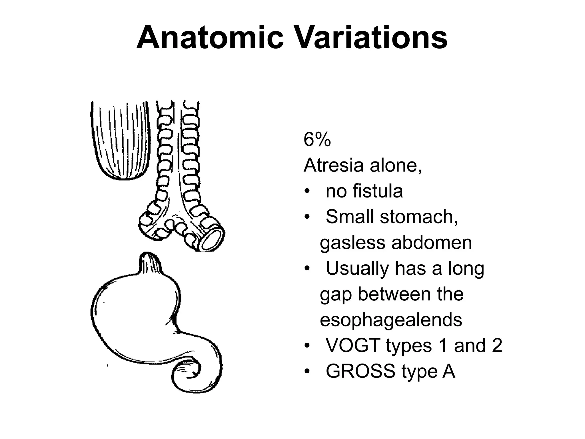 Anatomic Variations
6%
Atresia alone,
• no fistula
• Small stomach,
gasless abdomen
• Usually has a long
gap between the
esophagealends
• VOGT types 1 and 2
• GROSS type A
 