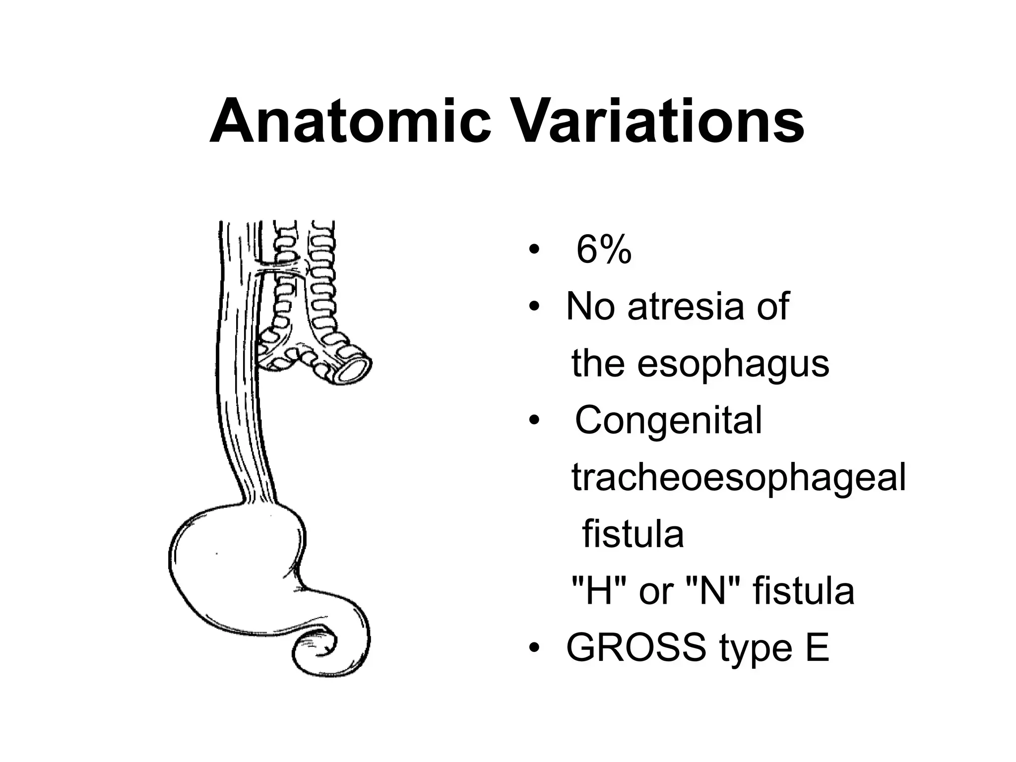 Anatomic Variations
• 6%
• No atresia of
the esophagus
• Congenital
tracheoesophageal
fistula
"H" or "N" fistula
• GROSS type E
 