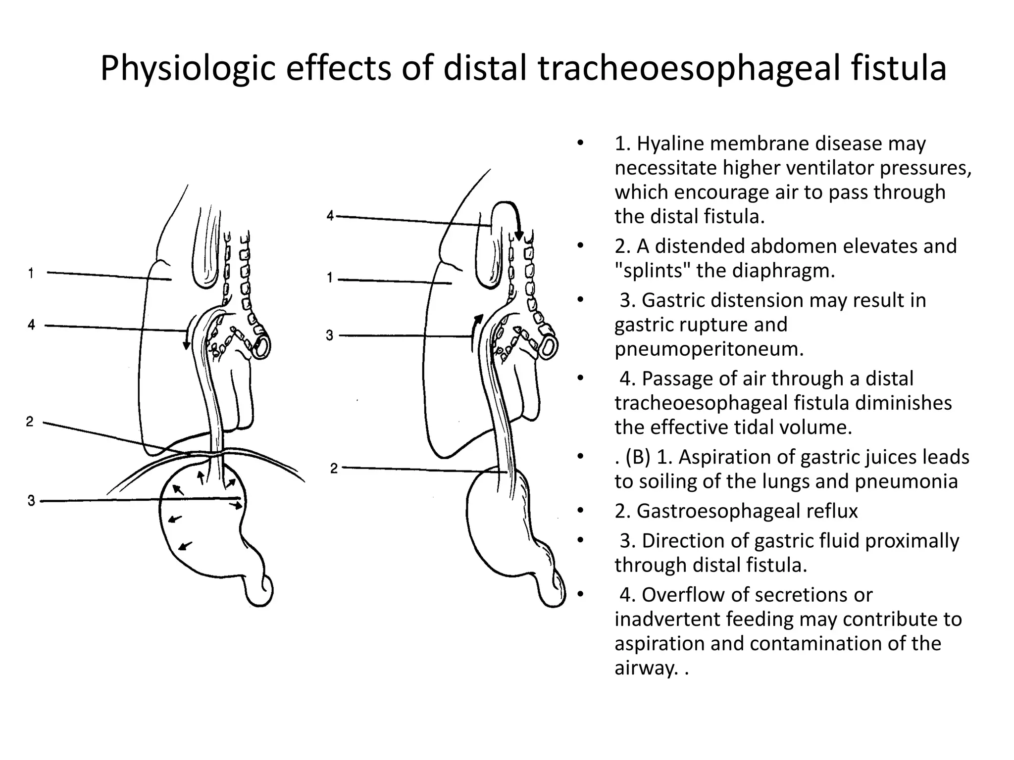 Physiologic effects of distal tracheoesophageal fistula
• 1. Hyaline membrane disease may
necessitate higher ventilator pressures,
which encourage air to pass through
the distal fistula.
• 2. A distended abdomen elevates and
"splints" the diaphragm.
• 3. Gastric distension may result in
gastric rupture and
pneumoperitoneum.
• 4. Passage of air through a distal
tracheoesophageal fistula diminishes
the effective tidal volume.
• . (B) 1. Aspiration of gastric juices leads
to soiling of the lungs and pneumonia
• 2. Gastroesophageal reflux
• 3. Direction of gastric fluid proximally
through distal fistula.
• 4. Overflow of secretions or
inadvertent feeding may contribute to
aspiration and contamination of the
airway. .
 