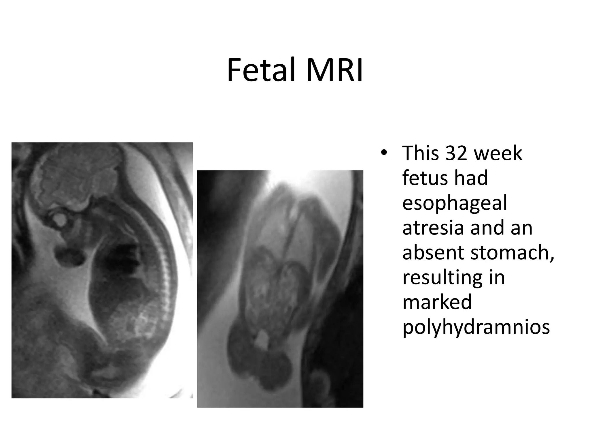 Fetal MRI
• This 32 week
fetus had
esophageal
atresia and an
absent stomach,
resulting in
marked
polyhydramnios
 