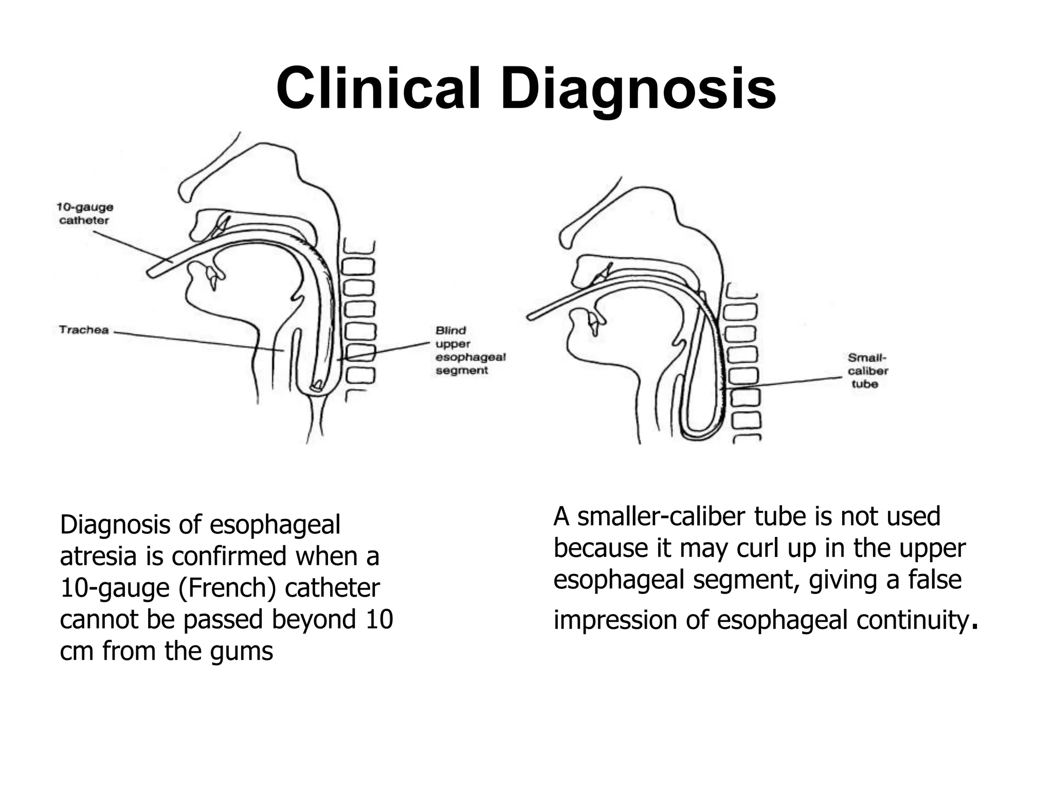 Clinical Diagnosis
Diagnosis of esophageal
atresia is confirmed when a
10-gauge (French) catheter
cannot be passed beyond 10
cm from the gums
A smaller-caliber tube is not used
because it may curl up in the upper
esophageal segment, giving a false
impression of esophageal continuity.
 