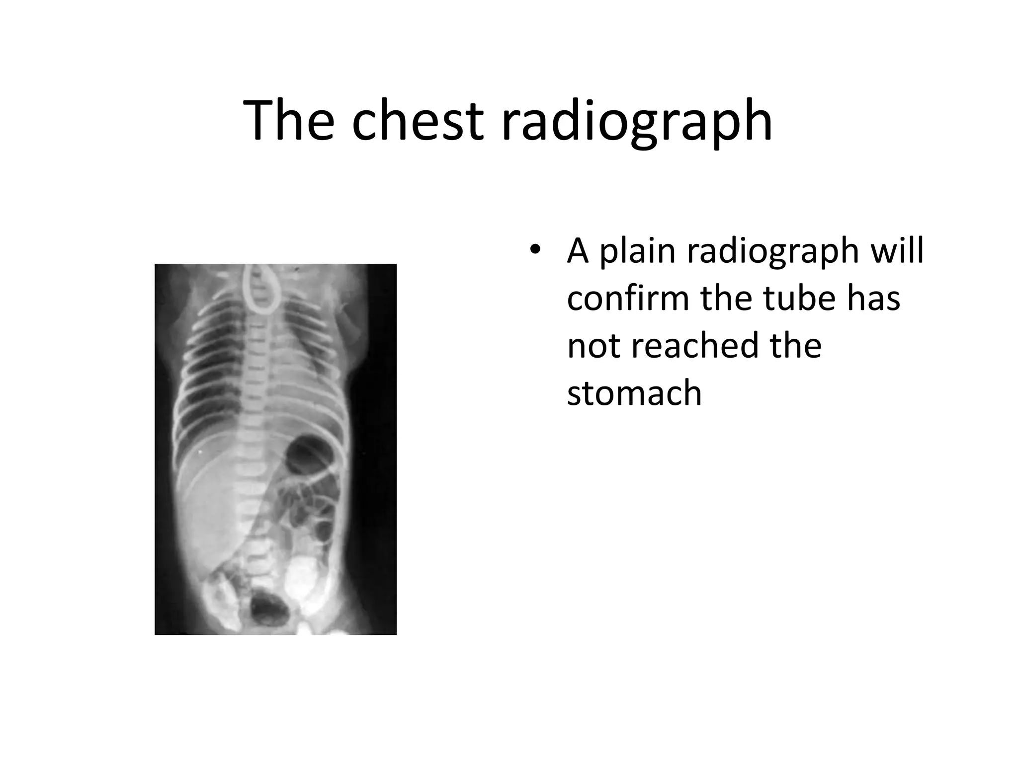 The chest radiograph
• A plain radiograph will
confirm the tube has
not reached the
stomach
 