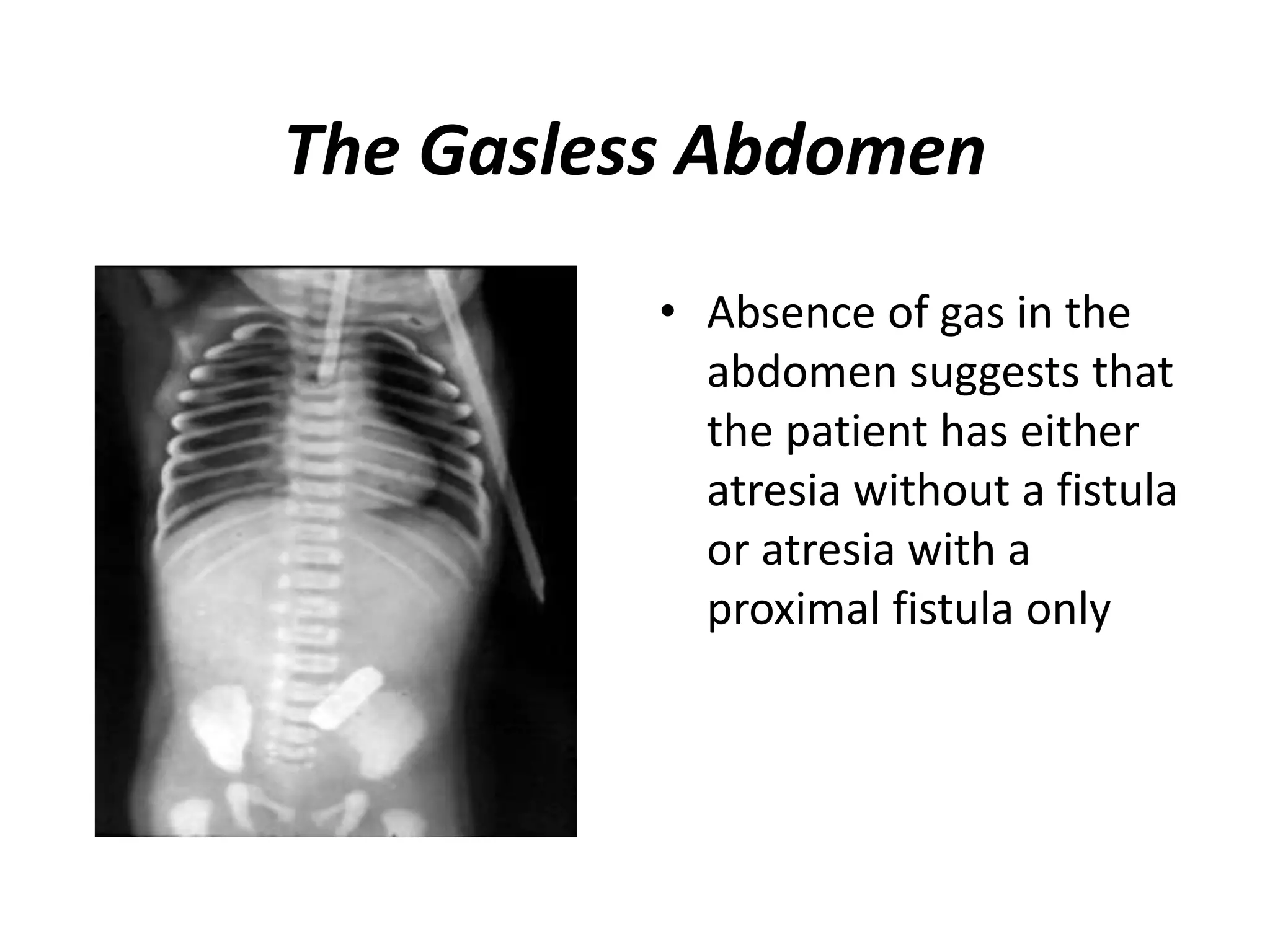 The Gasless Abdomen
• Absence of gas in the
abdomen suggests that
the patient has either
atresia without a fistula
or atresia with a
proximal fistula only
 