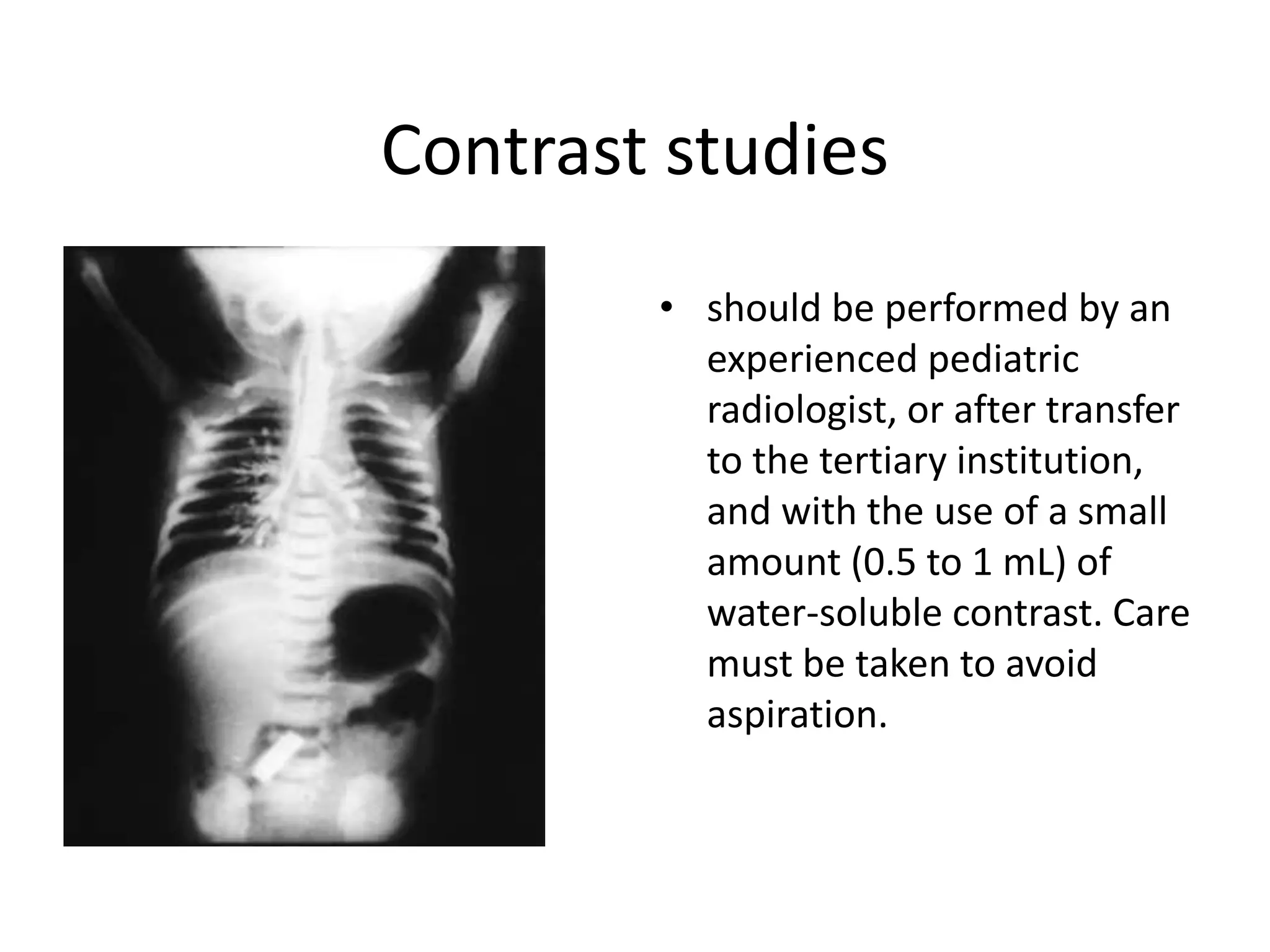 Contrast studies
• should be performed by an
experienced pediatric
radiologist, or after transfer
to the tertiary institution,
and with the use of a small
amount (0.5 to 1 mL) of
water-soluble contrast. Care
must be taken to avoid
aspiration.
 