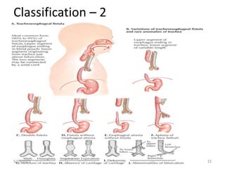 Tef Classification chapter 6-1 Esophageal atresia and TEF.ppt