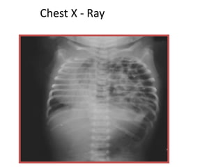 Chest X - Ray
 