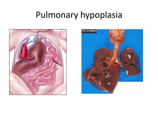 Pulmonary hypoplasia
 