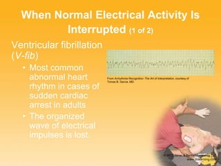 When Normal Electrical Activity Is
Interrupted (1 of 2)
Ventricular fibrillation
(V-fib)
• Most common
abnormal heart
rhythm in cases of
sudden cardiac
arrest in adults
• The organized
wave of electrical
impulses is lost.
From Arrhythmia Recognition: The Art of Interpretation, courtesy of
Tomas B. Garcia, MD.
 