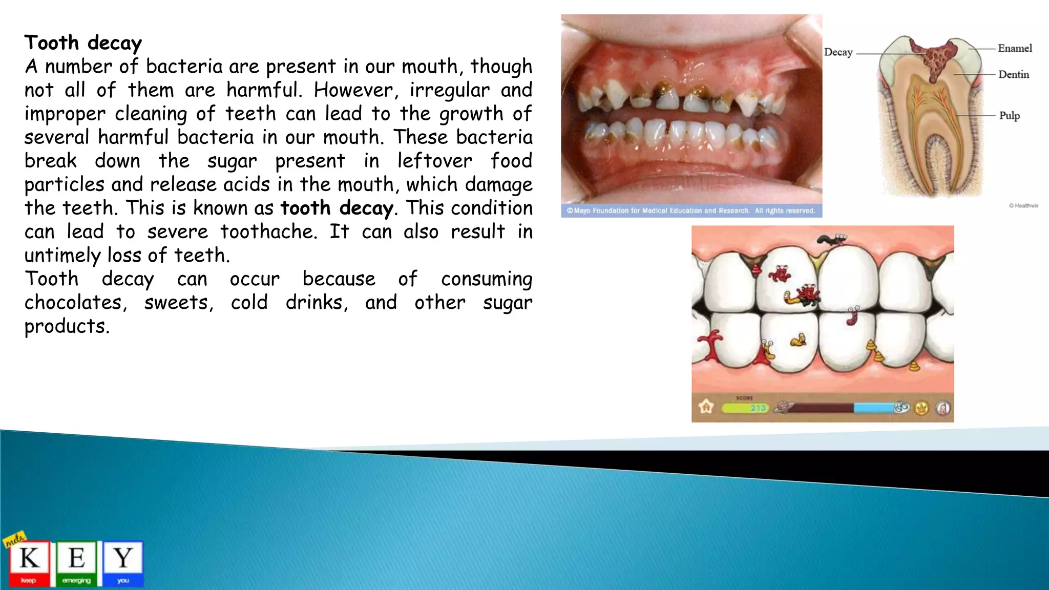 Tooth decay
A number of bacteria are present in our mouth, though
not all of them are harmful. However, irregular and
improper cleaning of teeth can lead to the growth of
several harmful bacteria in our mouth. These bacteria
break down the sugar present in leftover food
particles and release acids in the mouth, which damage
the teeth. This is known as tooth decay. This condition
can lead to severe toothache. It can also result in
untimely loss of teeth.
Tooth decay can occur because of consuming
chocolates, sweets, cold drinks, and other sugar
products.
 