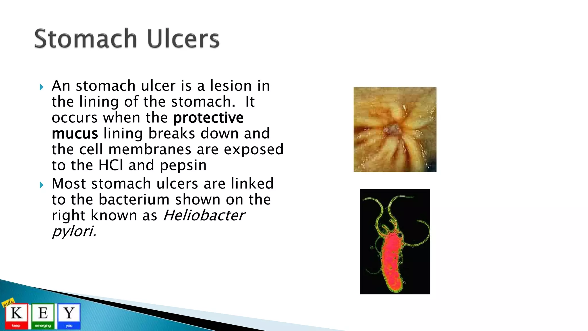  An stomach ulcer is a lesion in
the lining of the stomach. It
occurs when the protective
mucus lining breaks down and
the cell membranes are exposed
to the HCl and pepsin
 Most stomach ulcers are linked
to the bacterium shown on the
right known as Heliobacter
pylori.
 