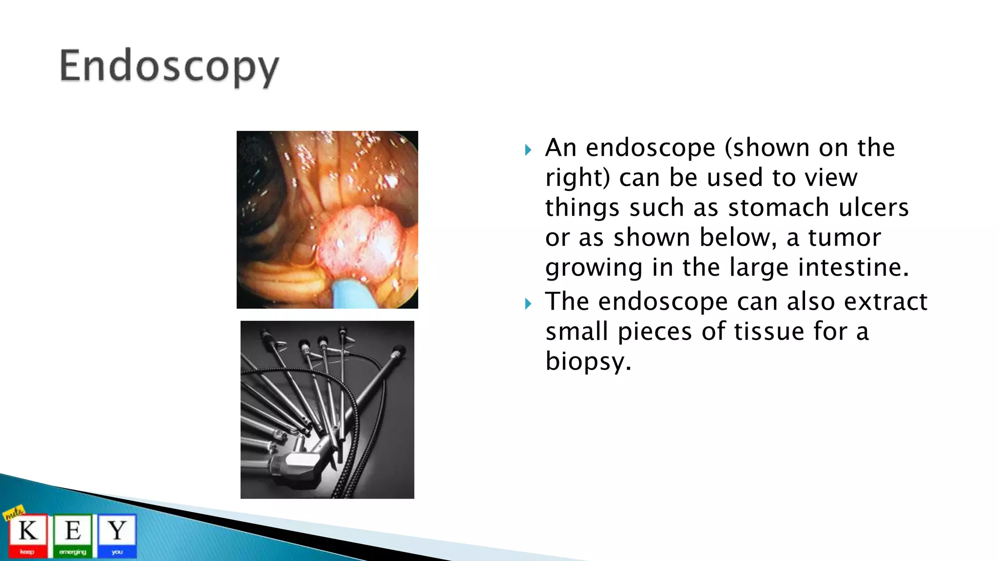  An endoscope (shown on the
right) can be used to view
things such as stomach ulcers
or as shown below, a tumor
growing in the large intestine.
 The endoscope can also extract
small pieces of tissue for a
biopsy.
 