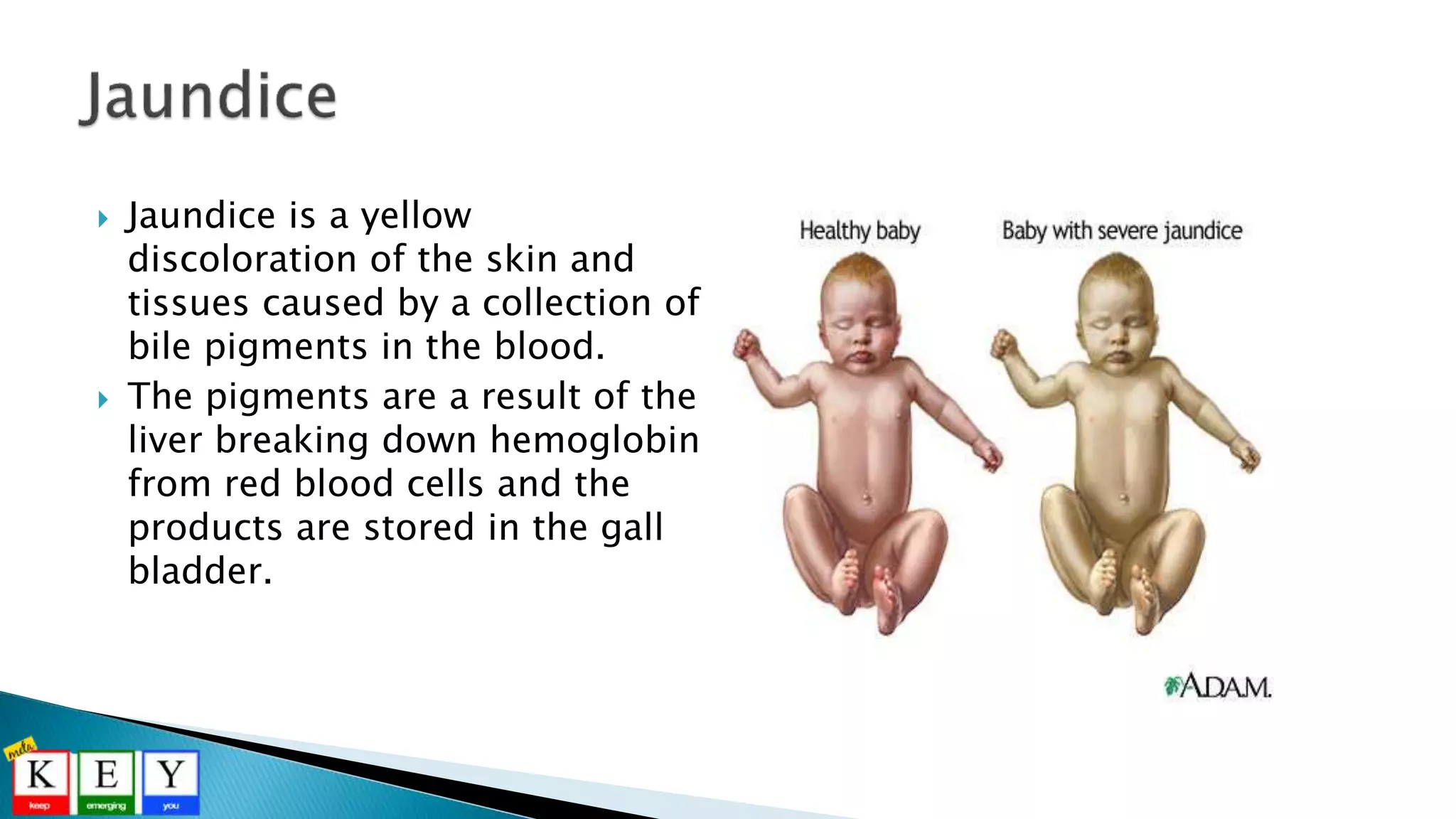  Jaundice is a yellow
discoloration of the skin and
tissues caused by a collection of
bile pigments in the blood.
 The pigments are a result of the
liver breaking down hemoglobin
from red blood cells and the
products are stored in the gall
bladder.
 