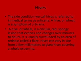 HivesThe skin condition we call hives is referred to in medical terms as urticaria. A hive, or wheal, is a symptom of urticaria. A hive, or wheal, is a circular, red, spongy lesion that evolves and changes over minutes to hours. It is usually surrounded by an area of redness called a flare. Hives can vary in size from a few millimeters to giant hives covering a whole extremity.