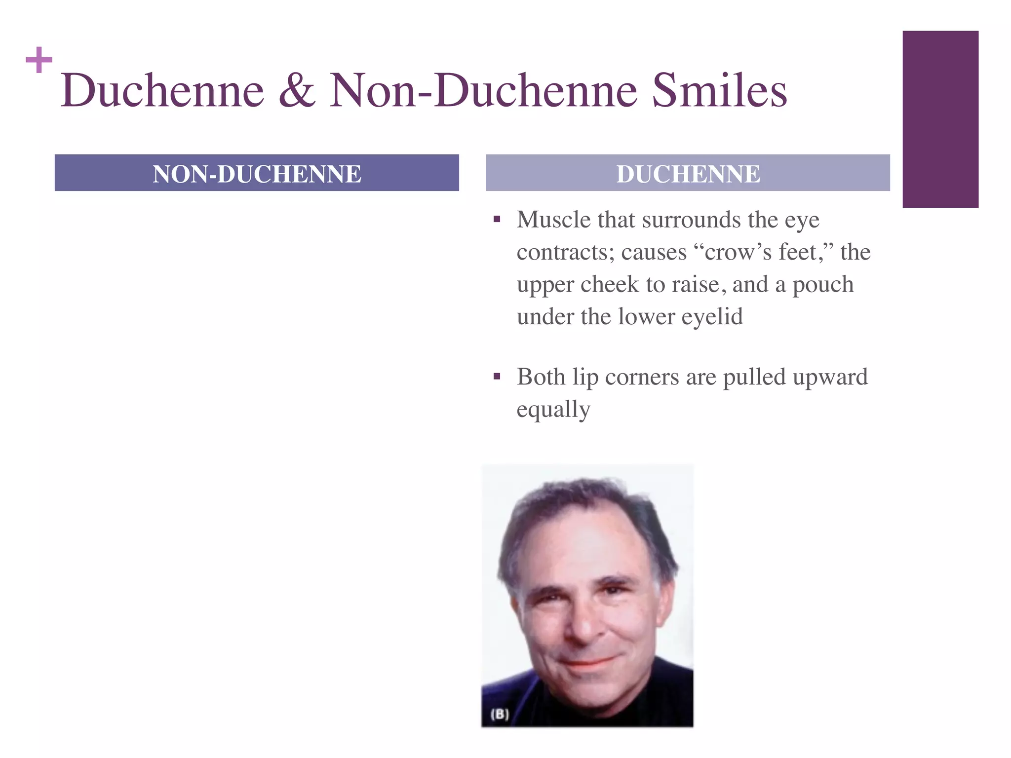 +
Duchenne & Non-Duchenne Smiles
■ Muscle that surrounds the eye
contracts; causes “crow’s feet,” the
upper cheek to raise, and a pouch
under the lower eyelid	

■ Both lip corners are pulled upward
equally
NON-DUCHENNE DUCHENNE
 