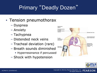 Copyright © 2016 by Pearson Education, Inc.
All Rights Reserved
Primary “Deadly Dozen”
• Tension pneumothorax
– Dyspnea
– Anxiety
– Tachypnea
– Distended neck veins
– Tracheal deviation (rare)
– Breath sounds diminished
 Hyperresonance if percussed
– Shock with hypotension
 