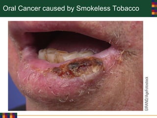Oral Cancer caused by Smokeless Tobacco
 