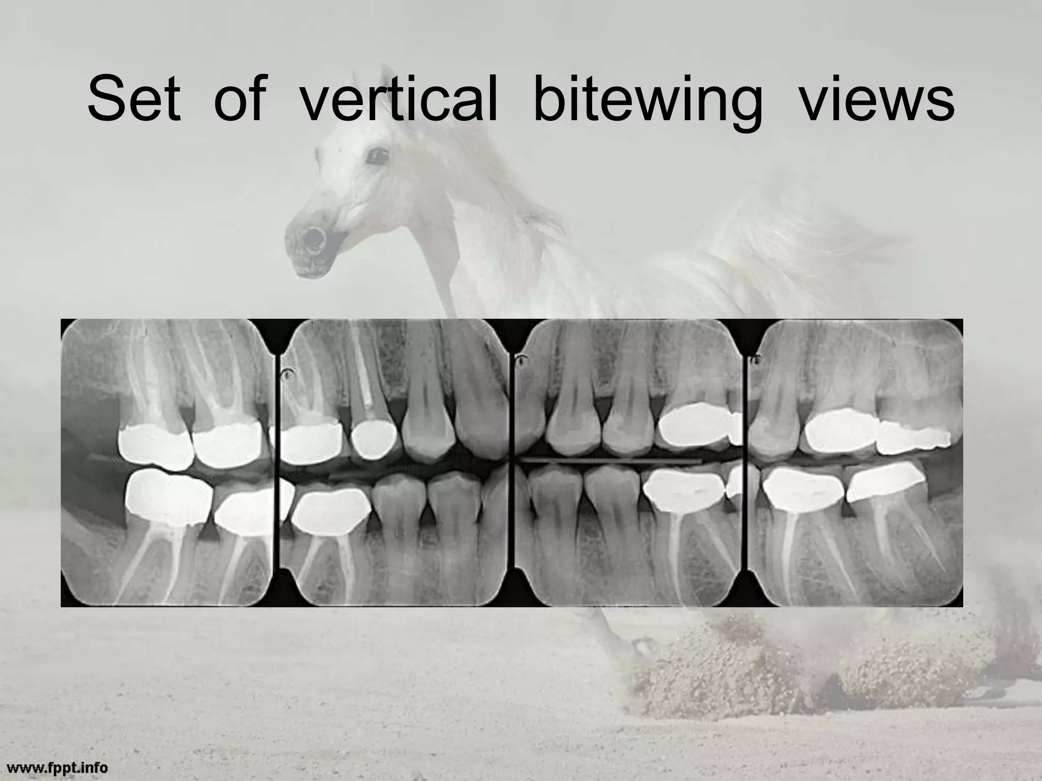 Set of vertical bitewing views
 