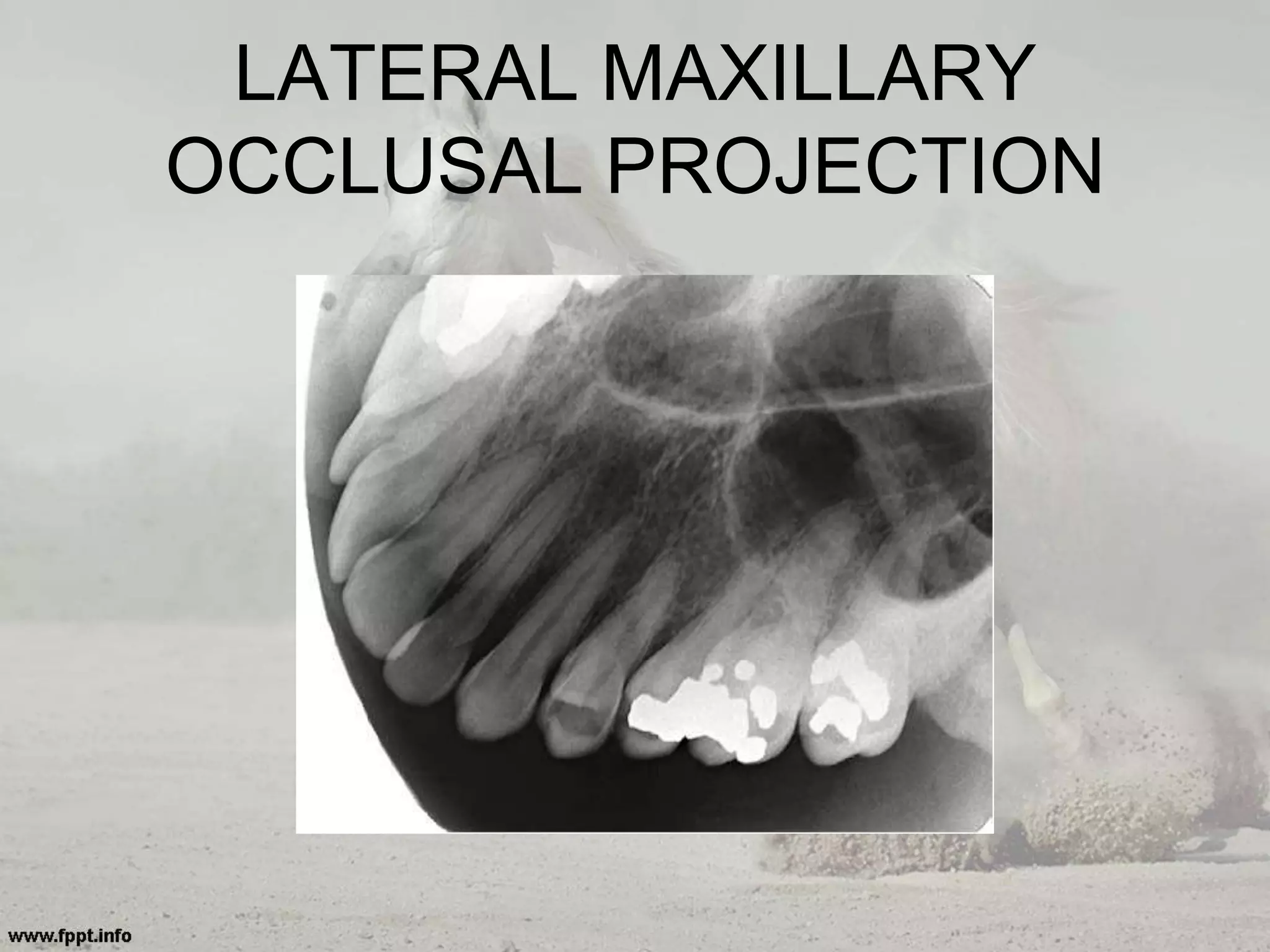 LATERAL MAXILLARY
OCCLUSAL PROJECTION
 