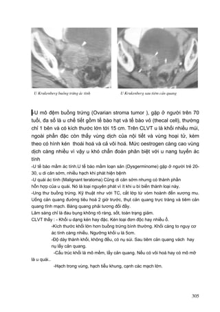 U Krukenberg buång trøng ¸c tÝnh

U Krukenberg sau tiªm c¶n quang

-U mô đệm buồng trứng (Ovarian stroma tumor ), gặp ở người trên 70
tuổi, đa số là u chế tiết gồm tế bào hạt và tế bào vỏ (thecal cell), thường
chỉ 1 bên và có kích thước lớn tới 15 cm. Trên CLVT u là khối nhiều múi,
ngoài phần đặc còn thấy vùng dịch của nội tiết và vùng hoại tử, kèm
theo có hình kén thoái hoá và cả vôi hoá. Mức oestrogen càng cao vùng
dịch càng nhiều vì vậy u khó chẩn đoán phân biệt với u nang tuyến ác
tính
-U tế bào mầm ác tính.U tế bào mầm loạn sản (Dysgerminome) gặp ở người trẻ 2030, u di căn sớm, nhiều hạch khi phát hiện bệnh
-U quái ác tính (Malignant teratoma) Cũng di căn sớm nhưng có thành phần
hỗn hợp của u quái. Nó là loại nguyên phát vì ít khi u bì biến thành loại này.
-Ung thư buồng trứng. Kỹ thuật như với TC, cắt lớp từ vòm hoành đến xương mu.
Uống cản quang đường tiêu hoá 2 giờ trước, thụt cản quang trực tràng và tiêm cản
quang tĩnh mạch. Bàng quang phải tương đối đầy.
Lâm sàng chỉ là đau bụng không rõ ràng, sốt, toàn trạng giảm.
CLVT thấy : - Khối u dạng kén hay đặc. Kén loại đơn độc hay nhiều ổ.
-Kích thước khối lớn hơn buồng trứng bình thường. Khối càng to nguy cơ
ác tính càng nhiều. Ngưỡng khối u là 5cm.
-Độ dày thành khối, không đều, có nụ sùi. Sau tiêm cản quang vách hay
nụ lấy cản quang.
-Cấu trúc khối là mô mềm, lấy cản quang. Nếu có vôi hoá hay có mô mỡ
là u quái..
-Hạch trong vùng, hạch tiểu khung, cạnh các mạch lớn.

305

 