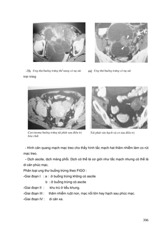 Ung th− ra chung quanh d©y ch»ng
-Th©m nhiÔmbuång trøng thÓ nang cã nô sïiréng, niÖu Ung th− buång trøngcung, ®¹i trµng sigma,
qu¶n, ruét non, të cã nô sïi

trùc trµng

Carcinoma buång trøng t¸i ph¸t sau ®iÒu trÞ
hãa chÊt

T¸i ph¸t vµo h¹ch vµ c¬ sau ®iÒu trÞ

- Hình cản quang mạch mạc treo cho thấy hình tắc mạch hat thâm nhiễm làm co rút
mạc treo.
- Dịch ascite, dịch màng phổi. Dịch có thể là cơ giới như tắc mạch nhưng có thể là
di căn phúc mạc.
Phân loại ung thư buồng trứng theo FIGO :
-Giai đoạn I : a : ở buồng trứng không có ascite
b : ở buồng trứng có ascite
-Giai đoạn II :

khu trú ở tiểu khung.

-Giai đoạn III :

thâm nhiễm ruột non, mạc nối lớn hay hạch sau phúc mạc.

-Giai đoạn IV :

di căn xa.

306

 