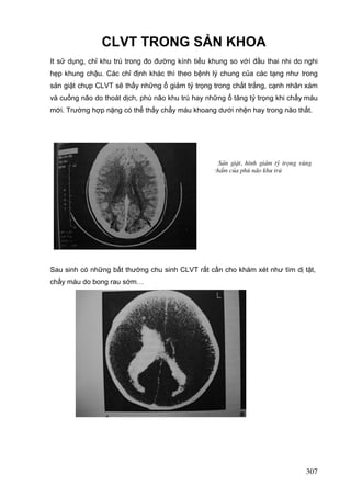 CLVT TRONG SẢN KHOA
It sử dụng, chỉ khu trú trong đo đường kính tiểu khung so vớí đầu thai nhi do nghi
hẹp khung chậu. Các chỉ định khác thì theo bệnh lý chung của các tạng như trong
sản giật chụp CLVT sẽ thấy những ổ giảm tỷ trọng trong chất trắng, cạnh nhân xám
và cuống não do thoát dịch, phù não khu trú hay những ổ tăng tỷ trọng khi chẩy máu
mới. Trường hợp nặng có thể thấy chẩy máu khoang dưới nhện hay trong não thất.

S¶n giËt, h×nh gi¶m tû träng vïng
chÈm cña phï n·o khu tró

Sau sinh có những bất thường chu sinh CLVT rất cần cho khám xét như tìm dị tật,
chẩy máu do bong rau sớm…

307

 