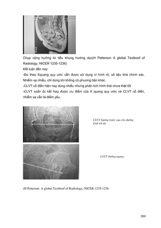 Chụp cộng hưởng từ tiểu khung hướng dọc(H Petterson A global Textboof of
Radiology, NICER 1235-1236)
Kết luận đến nay:
-Đo theo Xquang quy ước vẫn được sử dụng vì hình rõ, số liệu khá chính xác.
Nhiễm xạ nhiều, chỉ dùng khi không có phương tiện khác.
-CLVT cổ điển hiện nay dùng nhiều nhưng phân tích hình thái chưa thật tốt
-CLVT xoắn ốc kết hợp được ưu điểm của X quang quy ước và CLVT cổ điển,
nhiễm xạ vẫn là điểm yếu.

CLVT h−íng tr−íc sau cho ®−êng
kÝnh tèi ®a

CLVT h−íng ngang

(H Petterson A global Textboof of Radiology, NICER 1235-1236.

309

 