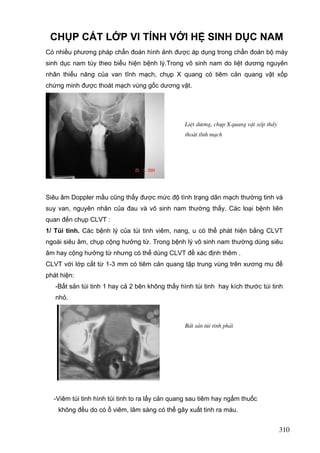 CHỤP CẮT LỚP VI TÍNH VỚI HỆ SINH DỤC NAM
Có nhiều phương pháp chẩn đoán hình ảnh được áp dụng trong chẩn đoán bộ máy
sinh dục nam tùy theo biểu hiện bệnh lý.Trong vô sinh nam do liệt dương nguyên
nhân thiểu năng của van tĩnh mạch, chụp X quang có tiêm cản quang vật xốp
chứng minh được thoát mạch vùng gốc dương vật.

LiÖt d−¬ng, chôp X quang vËt xèp thÊy
tho¸t tÜnh m¹ch

Siêu âm Doppler mầu cũng thấy được mức độ tình trạng dãn mạch thường tinh và
suy van, nguyên nhân của đau và vô sinh nam thường thấy. Các loại bệnh liên
quan đến chụp CLVT :
1/ Túi tinh. Các bệnh lý của túi tinh viêm, nang, u có thể phát hiện bằng CLVT
ngoài siêu âm, chụp cộng hưởng từ. Trong bệnh lý vô sinh nam thường dùng siêu
âm hay cộng hưởng từ nhưng có thể dùng CLVT đề xác định thêm .
CLVT với lớp cắt từ 1-3 mm có tiêm cản quang tập trung vùng trên xương mu để
phát hiện:
-Bất sản túi tinh 1 hay cả 2 bên không thấy hình túi tinh hay kích thước túi tinh
nhỏ.

BÊt s¶n tói tinh ph¶i

-Viêm túi tinh hình túi tinh to ra lấy cản quang sau tiêm hay ngấm thuốc
không đều do có ổ viêm, lâm sàng có thể gây xuất tinh ra máu.

310

 