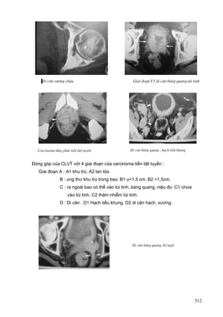 Di c¨n x−¬ng chËu

Carcinoma thïy ph¶i tiÒn liÖt tuyÕn

Giai ®o¹n T3 di c¨n bµng quang,tói tinh

Di c¨n bµng quang , h¹ch tiÓu khung

Đóng góp của CLVT với 4 giai đoạn của carcinoma tiền liệt tuyến :
Giai đoạn A : A1 khu trú, A2 lan tỏa
B : ung thư khu trú trong bao. B1 u<1,5 cm. B2 >1,5cm.
C : ra ngoài bao có thể vào túi tinh, bàng quang, niệu đo. C1 chưa
vào túi tinh. C2 thâm nhiễm túi tinh.
D : Di căn . D1 Hạch tiểu khung. D2 di căn hạch, xương.

Di c¨n bµng quang, hè ngåi

312

 