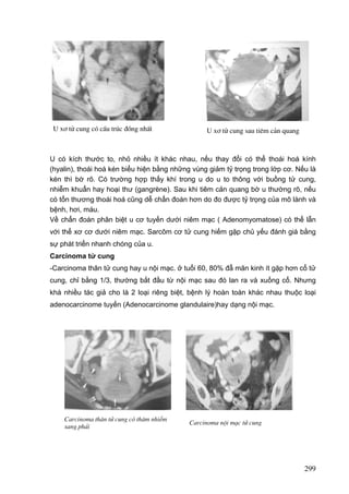 U x¬ tö cung cã cÊu tróc ®ång nhÊt

U x¬ tö cung sau tiªm c¶n quang

U có kích thước to, nhỏ nhiều ít khác nhau, nếu thay đổi có thể thoái hoá kính
(hyalin), thoái hoá kén biểu hiện bằng những vùng giảm tỷ trọng trong lớp cơ. Nếu là
kén thì bờ rõ. Có trường hợp thấy khí trong u do u to thông với buồng tử cung,
nhiễm khuẩn hay hoại thư (gangrène). Sau khi tiêm cản quang bờ u thường rõ, nếu
có tổn thương thoái hoá cũng dễ chẩn đoán hơn do đo được tỷ trọng của mô lành và
bệnh, hơi, máu.
Về chẩn đoán phân biệt u cơ tuyến dưới niêm mạc ( Adenomyomatose) có thể lẫn
với thể xơ cơ dưới niêm mạc. Sarcôm cơ tử cung hiếm gặp chủ yếu đánh giá bằng
sự phát triển nhanh chóng của u.
Carcinoma tử cung
-Carcinoma thân tử cung hay u nội mạc. ở tuổi 60, 80% đẫ mãn kinh ít gặp hơn cổ tử
cung, chỉ bằng 1/3, thường bắt đầu từ nội mạc sau đó lan ra và xuống cổ. Nhưng
khá nhiều tác giả cho là 2 loại riêng biệt, bệnh lý hoàn toàn khác nhau thuộc loại
adenocarcinome tuyến (Adenocarcinome glandulaire)hay dạng nội mạc.

Carcinoma th©n tö cung cã th©m nhiÔm
sang ph¶i

Carcinoma néi m¹c tö cung

299

 