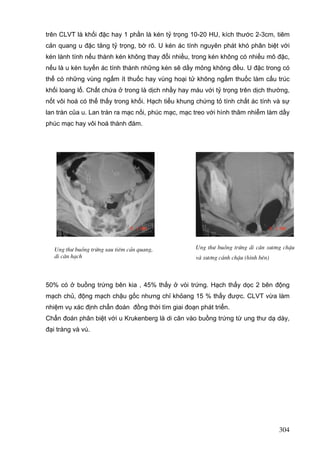 trên CLVT là khối đặc hay 1 phần là kén tỷ trọng 10-20 HU, kích thước 2-3cm, tiêm
cản quang u đặc tăng tỷ trọng, bờ rõ. U kén ác tính nguyên phát khó phân biệt với
kén lành tính nếu thành kén không thay đổi nhiều, trong kén không có nhiều mô đặc,
nếu là u kén tuyến ác tính thành những kén sẽ dầy mỏng không đều. U đặc trong có
thể có những vùng ngấm ít thuốc hay vùng hoại tử không ngấm thuốc làm cấu trúc
khối loang lổ. Chất chứa ở trong là dịch nhầy hay máu với tỷ trọng trên dịch thường,
nốt vôi hoá có thể thấy trong khối. Hạch tiểu khung chứng tỏ tính chất ác tính và sự
lan tràn của u. Lan tràn ra mạc nối, phúc mạc, mạc treo với hình thâm nhiễm làm dầy
phúc mạc hay vôi hoá thành đám.

Ung th− buång trøng sau tiªm c¶n quang,
di c¨n h¹ch

Ung th− buång trøng di c¨n x−¬ng chËu
vµ x−¬ng c¸nh chËu (h×nh bªn)

50% có ở buồng trứng bên kia , 45% thấy ở vòi trứng. Hạch thấy dọc 2 bên động
mạch chủ, động mạch chậu gốc nhưng chỉ khỏang 15 % thấy được. CLVT vừa làm
nhiệm vụ xác định chẩn đoán đồng thời tìm giai đoạn phát triển.
Chẩn đoán phân biệt với u Krukenberg là di căn vào buồng trứng từ ung thư dạ dày,
đại tràng và vú.

304

 