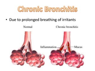 • Due to prolonged breathing of irritants 
 