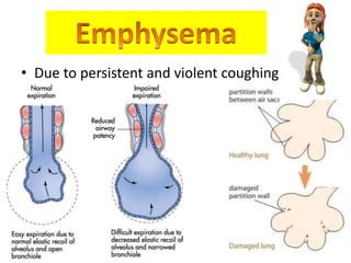 • Due to persistent and violent coughing 
 
