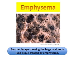 http://www.flickr.com/photos/pulmonary_pathology 
/ 
Another image showing the large cavities in 
lung tissue created by emphysema. 
 
