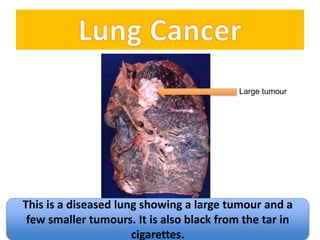 This is a diseased lung showing a large tumour and a 
few smaller tumours. It is also black from the tar in 
cigarettes. 
Large tumour 
 