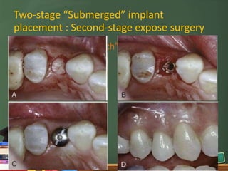 Standard Implant surgical procedure | PPTX