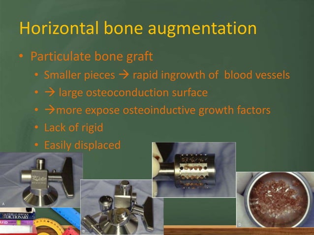 Localized bone augmentation and implant site development | PPTX