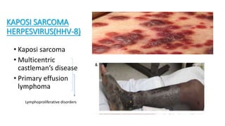 KAPOSI SARCOMA
HERPESVIRUS(HHV-8)
• Kaposi sarcoma
• Multicentric
castleman’s disease
• Primary effusion
lymphoma
Lymphoproliferative disorders
 