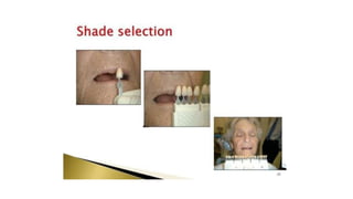 Teeth selection for complete denture                   