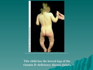 This child has the bowed legs of the  vitamin D–deficiency disease rickets. ©2003 Wadsworth, a division of Thomson Learning, Inc.  Thomson Learning ™  is a trademark used herein under license. 