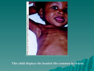 This child displays the beaded ribs common in rickets. ©2003 Wadsworth, a division of Thomson Learning, Inc.  Thomson Learning ™  is a trademark used herein under license. 