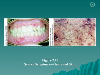 Figure 7.10 Scurvy Symptoms—Gums and Skin  ©2003 Wadsworth, a division of Thomson Learning, Inc.  Thomson Learning ™  is a trademark used herein under license. 0 