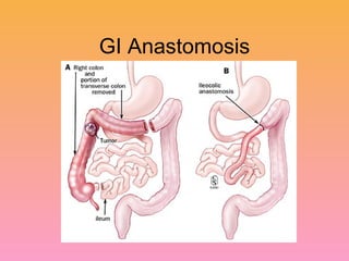 GI Anastomosis 