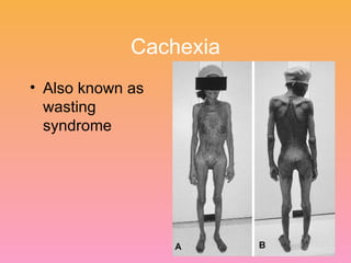 Cachexia Also known as wasting syndrome 