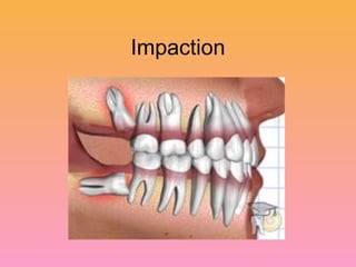 Impaction 