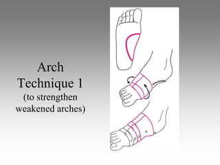 Arch
Technique 1
 (to strengthen
weakened arches)
 