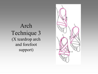 Arch
Technique 3
(X teardrop arch
  and forefoot
    support)
 