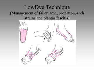 LowDye Technique
(Management of fallen arch, pronation, arch
       strains and plantar fascitis)
                     (
 